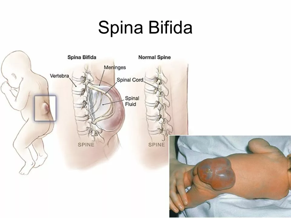The connection between spina bifida and bladder and bowel problems