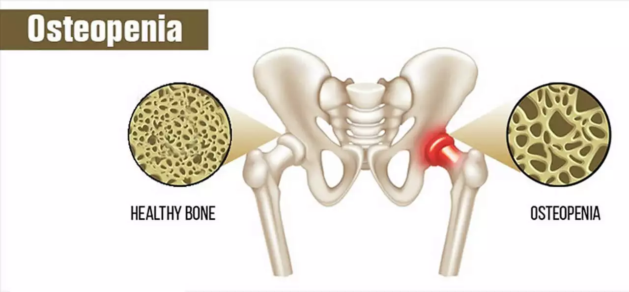 Amlodipine and Osteoporosis: Can This Medication Affect Bone Health?
